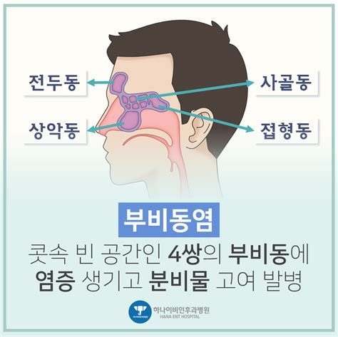 부비동염