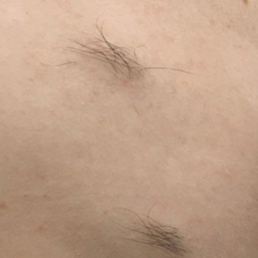 신경섬유종 초기 증상, 혹시 나도? 놓치면 안 되는 신호