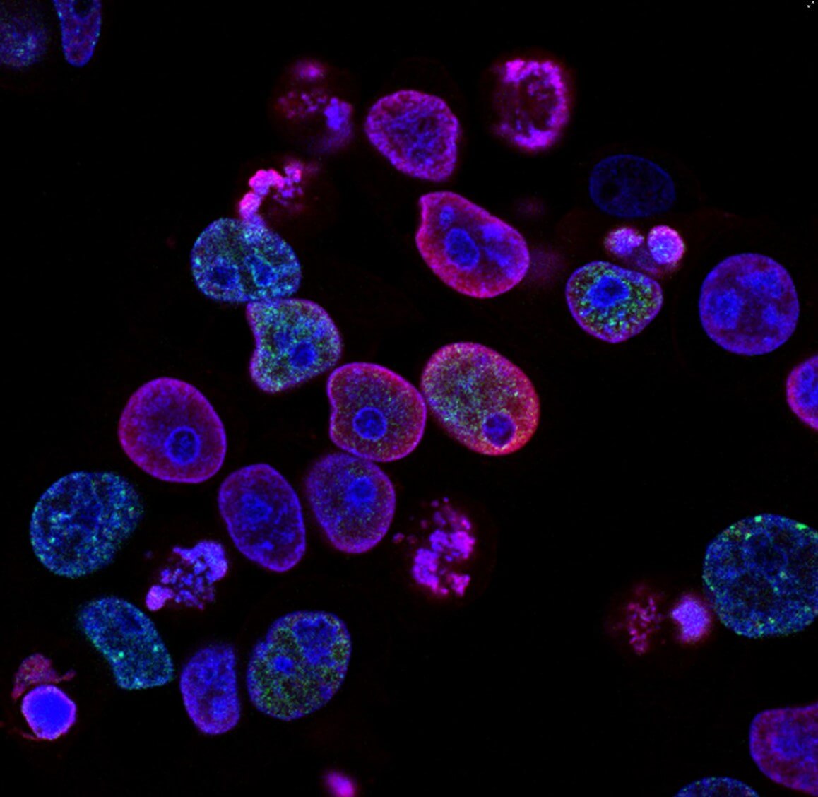 암! CAR-T 세포 치료의 모든 것: 국내 치료센터 및 임상 성공 사례