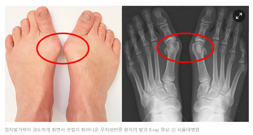 무지외반증 사진