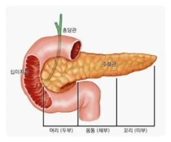 췌장암 초기 증상 췌장암 등통증 위치 검사_23