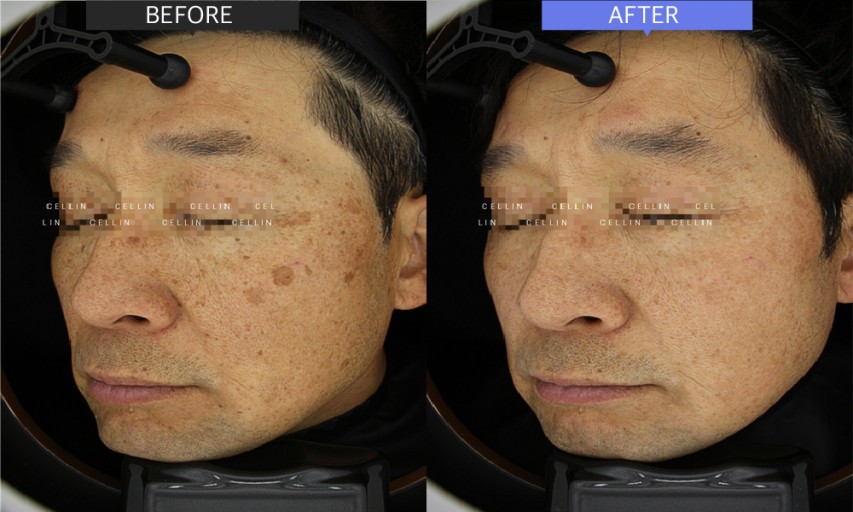 피코레이저 시술전후