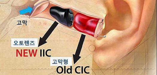 초소형 보청기 가격