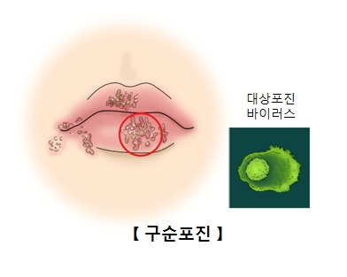 입술 헤르페스 원인