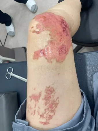 2도 화상 증상 자가치료 회복기간 응급처치법 정리_14