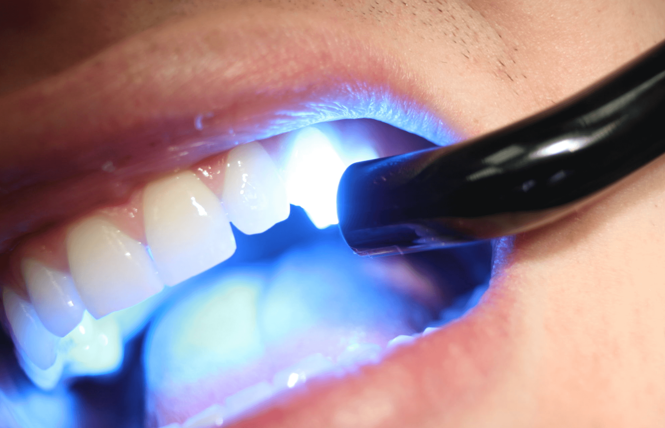 치아-깨짐-레진