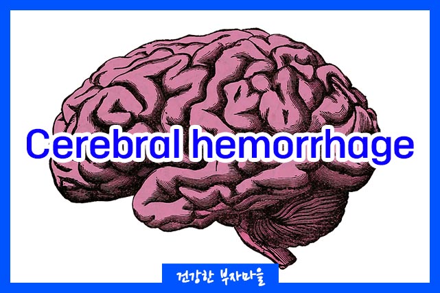 뇌출혈 전조증상 7가지