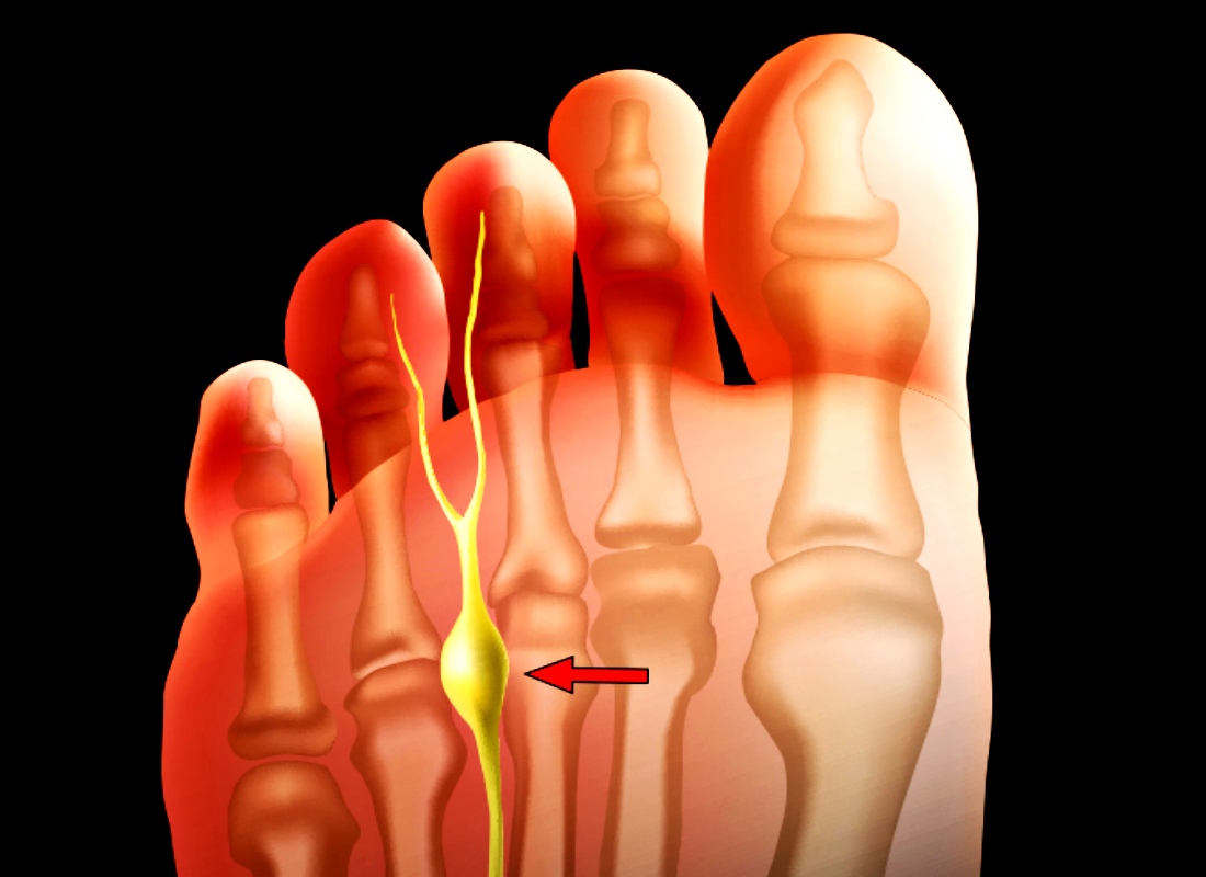 지간신경종 사진