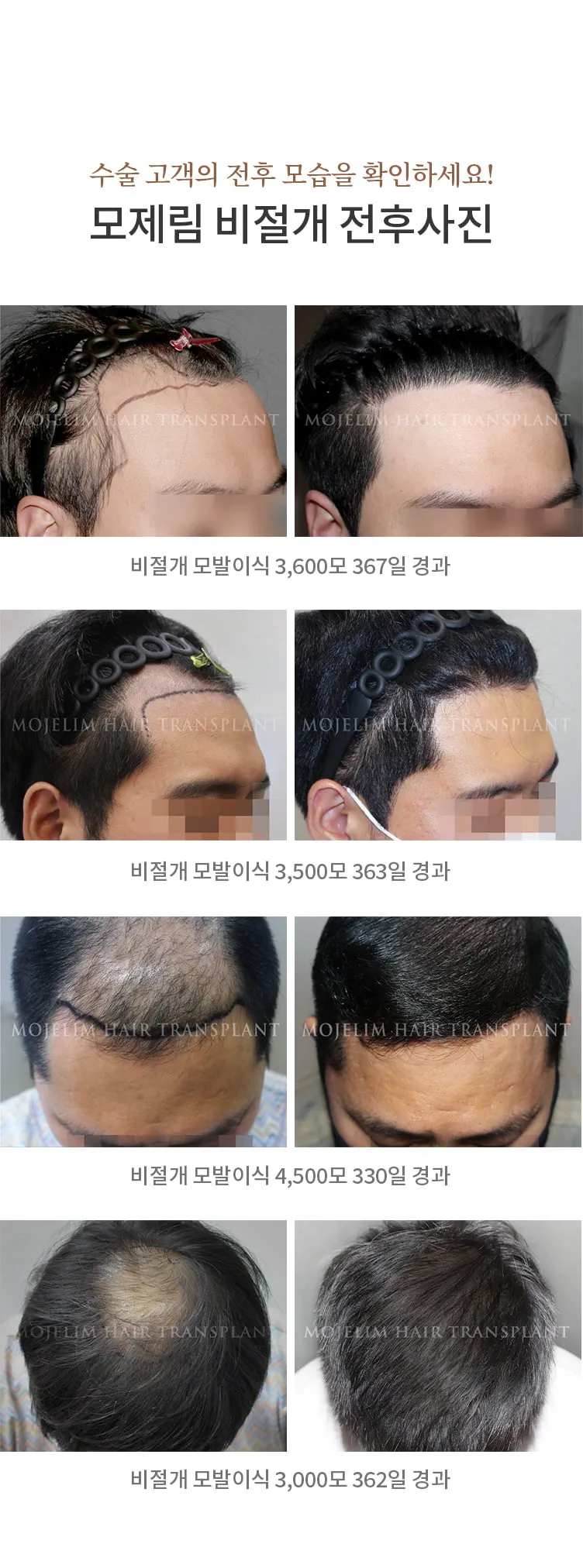 머리카락 이식 3000모 3000모낭 비용과 시술 과정_3
