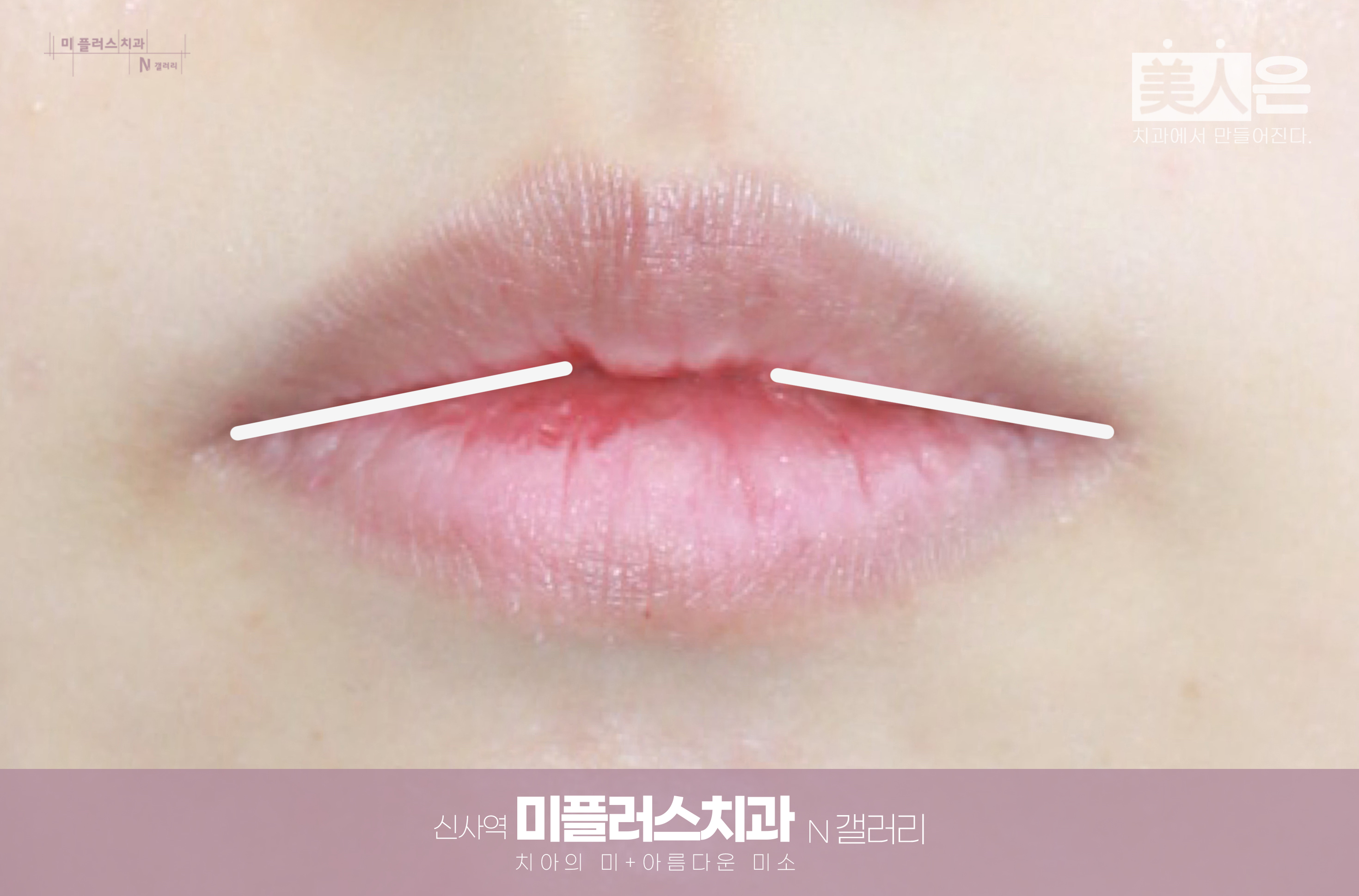 입꼬리가 아래로 향하는 입매 형태를 설명하는 예시 이미지