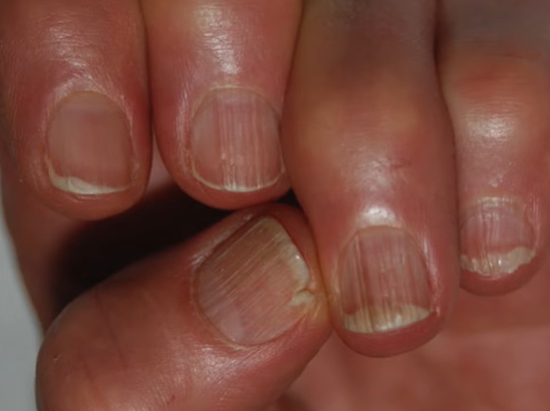 손톱이 잘 부러지는 이유