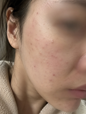 리쥬란 힐러 시술 후 얼굴 뺨에 올록볼록하게 올라온 엠보싱 자국과 미세한 바늘 멍, 붉은기 현상