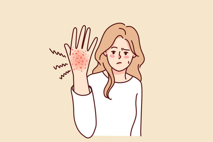 건선 증상과 자가치료
