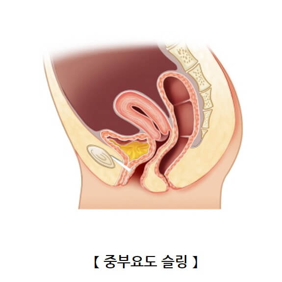 요실금 치료방법, 요실금 수술 비용, 요실금 팬티, 요실금 치료기 추천, 요실금 병원