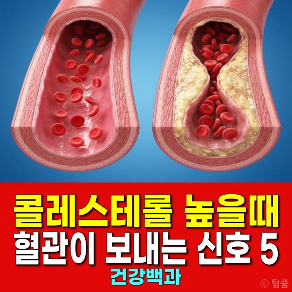 콜레스테롤 수치 높으면 혈관 생로병사의 비밀