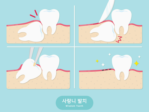 사랑니 발치 후 식사 가이드