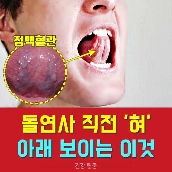 혀 아래 정맥 돌연사 전조증상 혀 이상증세