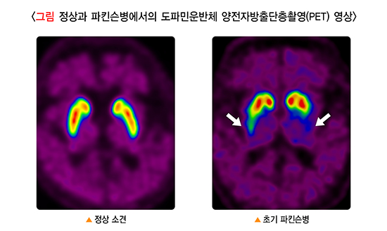 파킨슨병 도파민감소 PET사진