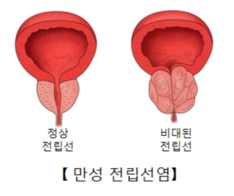 정상전립선과-비대증전립선-차이