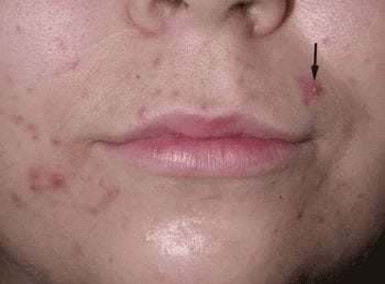 피부에 여드름난 인물 사진