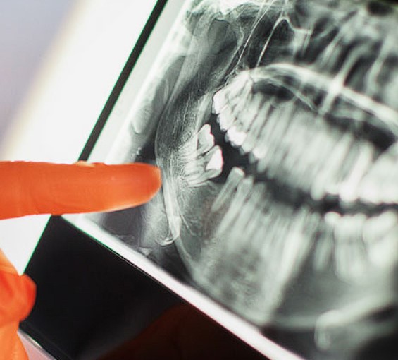 뼈이식-임플란트-비용