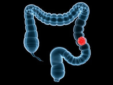 대장에 좋은 음식과 안 좋은 음식