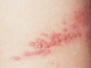 대상포진 예방접종