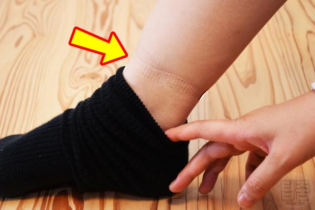 다리 양말자국 질환 코끼리다리 무다리 원인