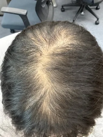 정수리가 아픈 이유와 완화하는 방법_7