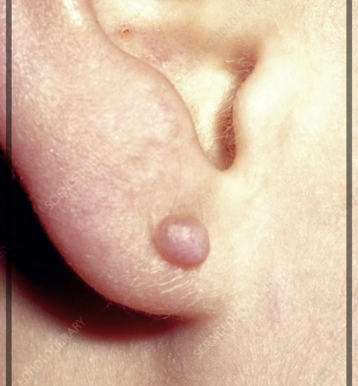 귀 몽우리 생기는 원인 및 해결방법