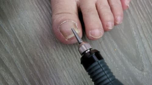 발톱 무좀 치료