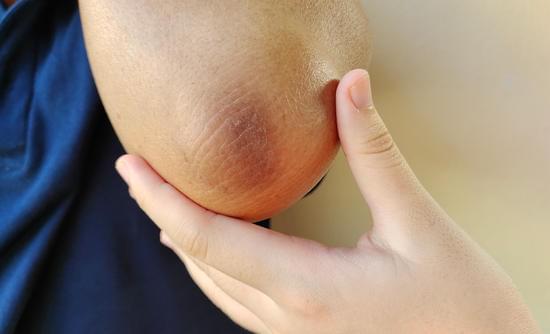 까만 팔꿈치 탈출하는 방법: 어두워진 피부를 밝히는 팁