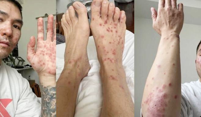 국내 엠폭스 증상 원인