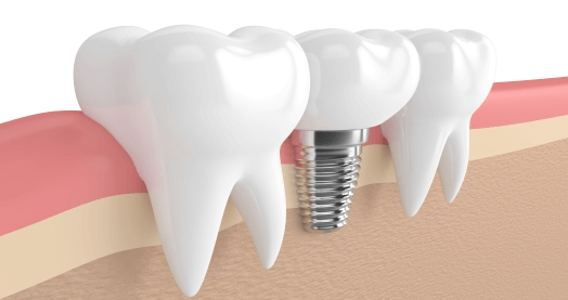 임플란트 의료보험 적용나이