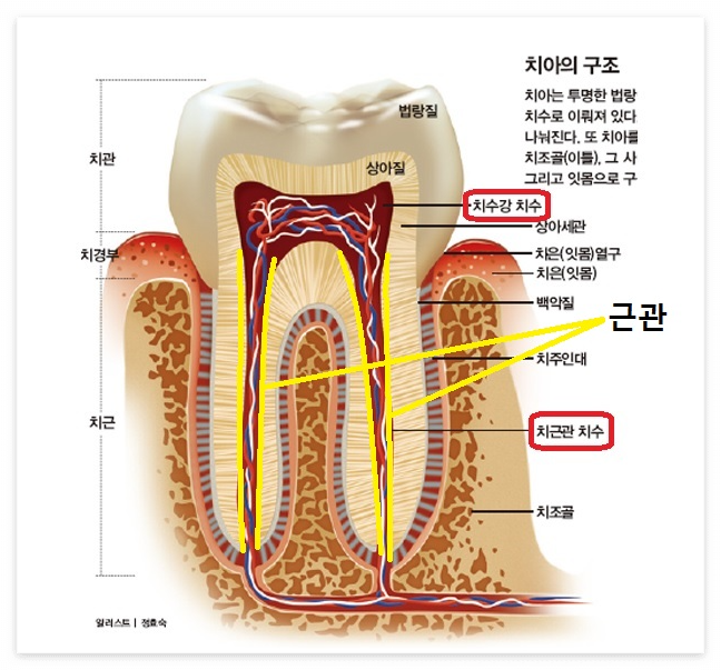치과 신경치료와 크라운치료