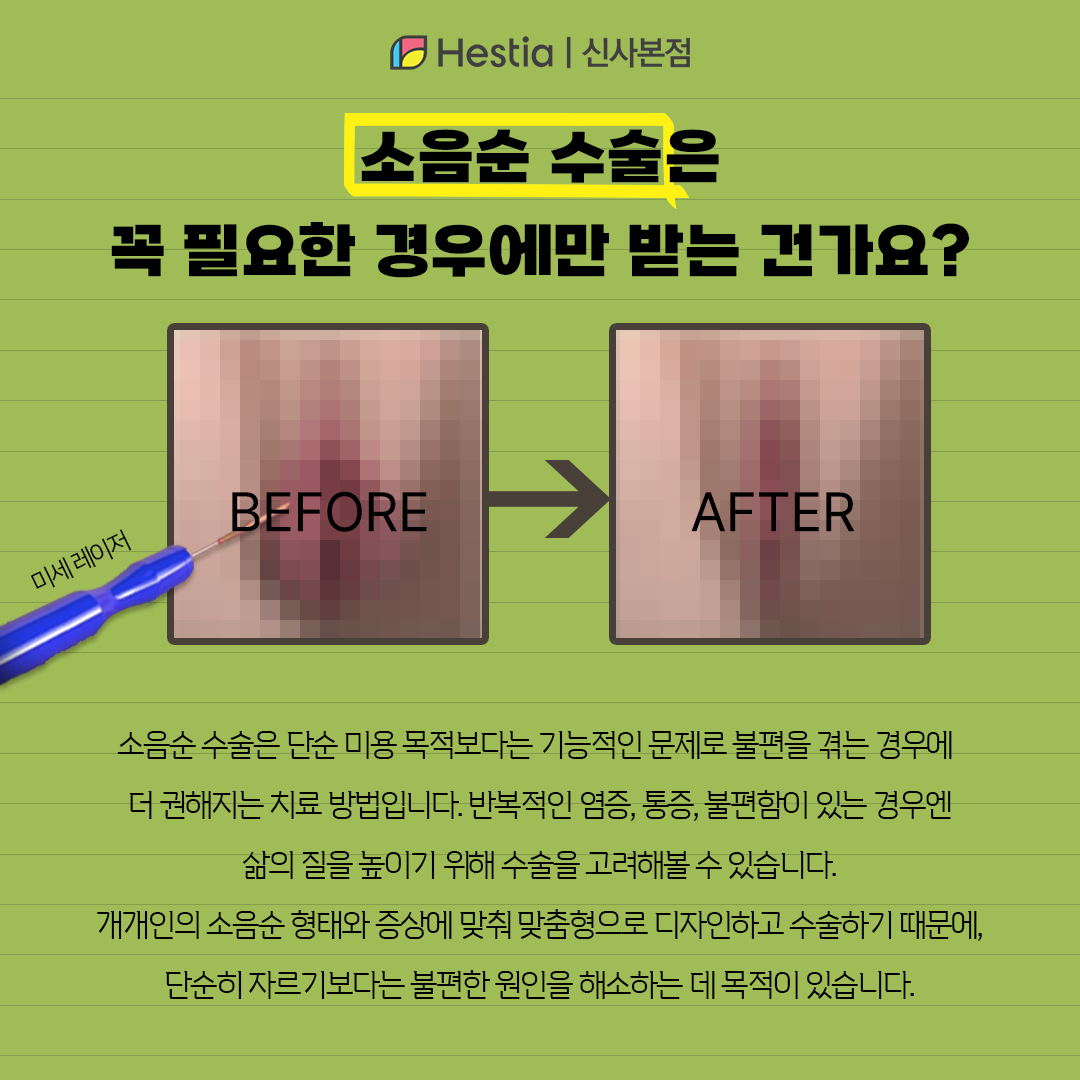 소음순수술은 꼭 필요한 경우에만 받나요?