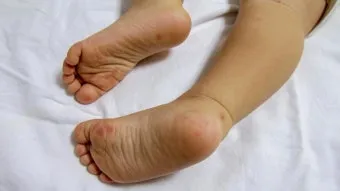 수족구병 증상과 예방 조치 방법 모음_23