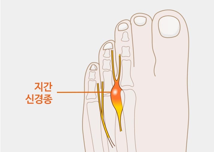 발바닥 통증부위&amp;#44; 발바닥 혈자리&amp;#44; 발바닥 통증&amp;#44; 발바닥 지압점그리기&amp;#44; 발바닥 저림증상&amp;#44; 발바닥 굳은살 원인&amp;#44; 발바닥 파스 효과&amp;#44; 발바닥 핫팩&amp;#44; 발바닥 티눈 없내는 법&amp;#44; 발바닥 지압매트&amp;#44; 발바닥 무좀&amp;#44; 발바닥 통증 치료&amp;#44; 발바닥 통증 스트레칭&amp;#44; 왼쪽 발바닥 통증&amp;#44; 오른쪽 발바닥 통증&amp;#44; 허리 디스크 발바닥 통증