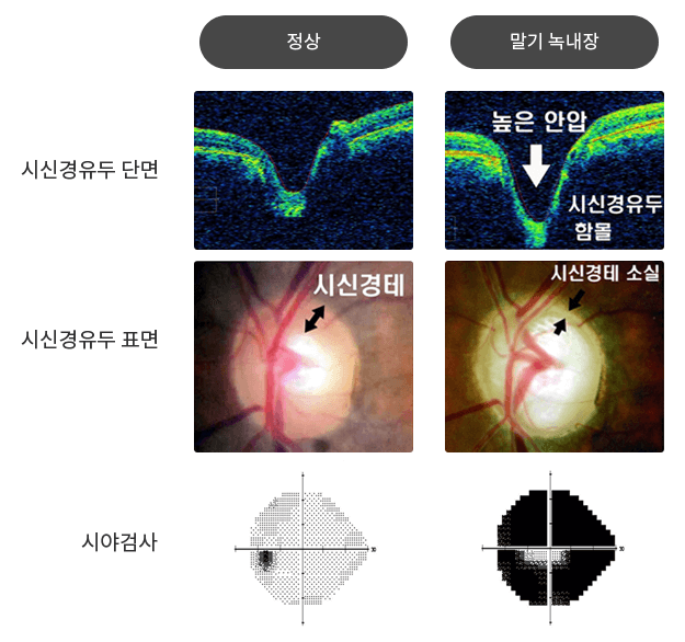 말기-녹내장-시신경