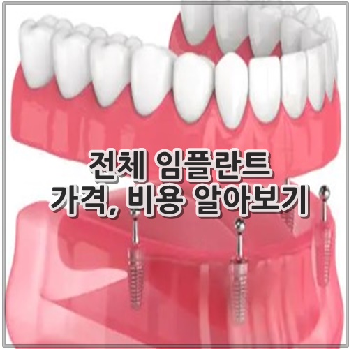 전체 임플란트 가격, 비용 알아보기