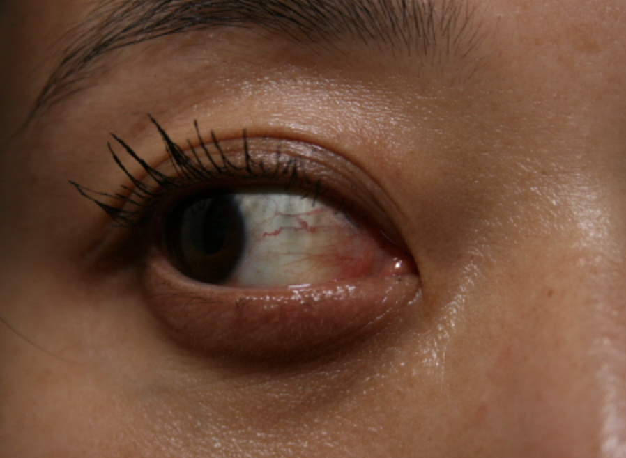 눈에 실핏줄이 터지지 않는 예방법