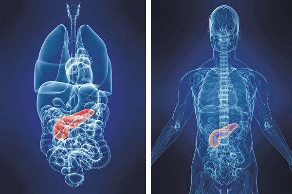 췌장암 초기 증상