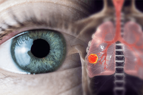 폐암초기증상10