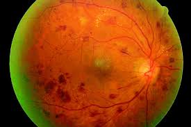 눈 실핏줄이 터지는 이유