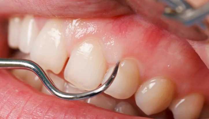 치은염 증상 8가지 및 치은염 치료방법 영양제 추천