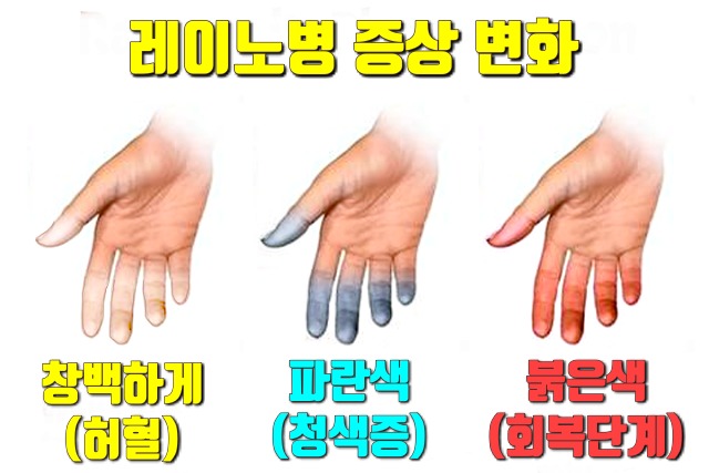 추울때 손가락 끝이 하얗게 레이노 증후군 증상