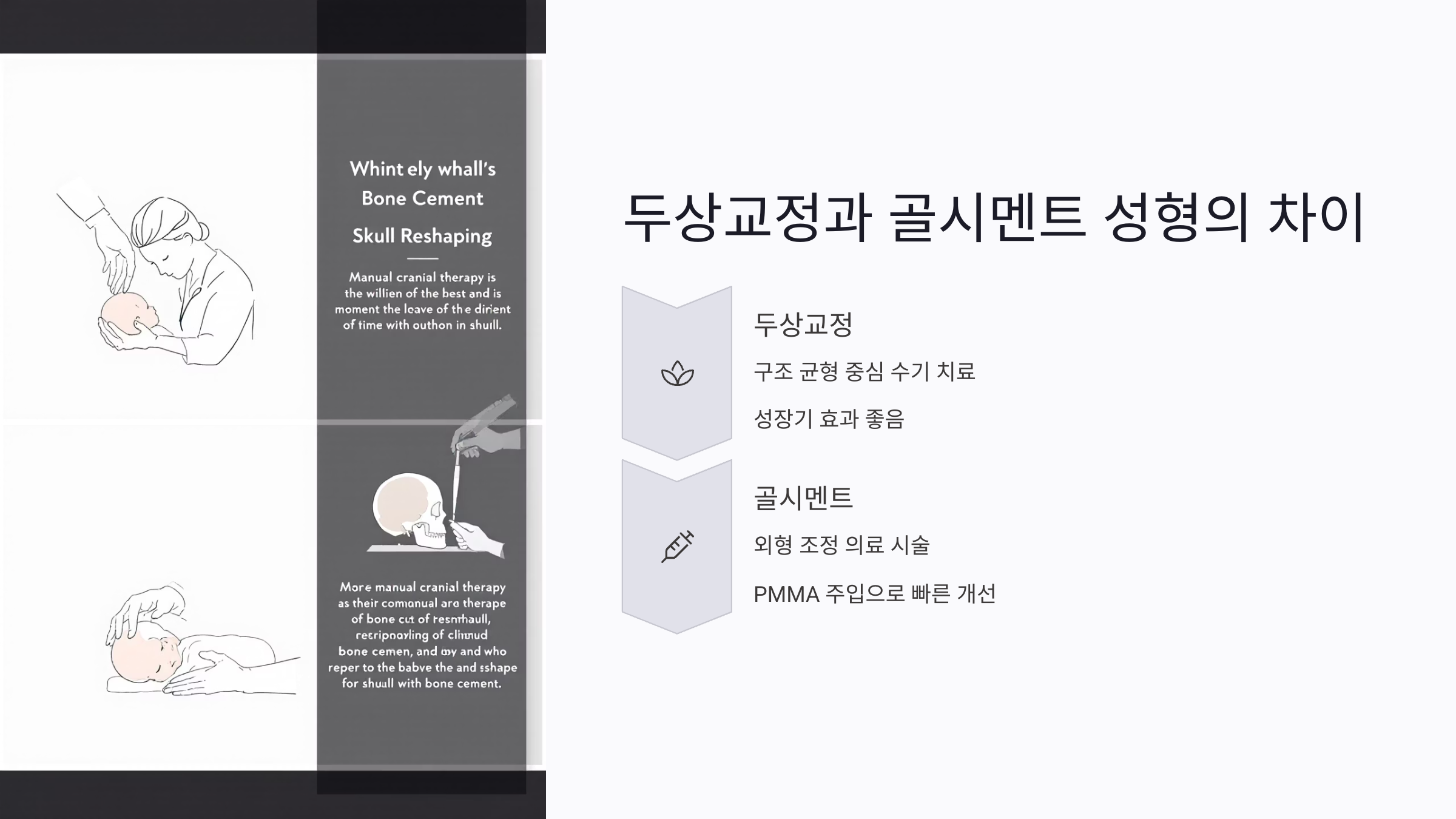 두상교정과 골시멘트 두상 성형의 차이