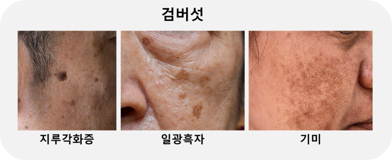 검버섯 없애는 방법