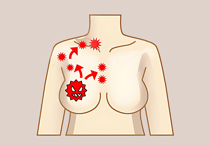 림프절-부종이-발생한-여성