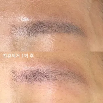 눈썹 문신 제거 방법 꿀팁_22